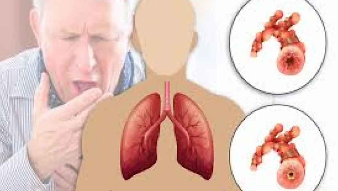 KOAH’ın Yüzde 80’i Sigara Kaynaklı