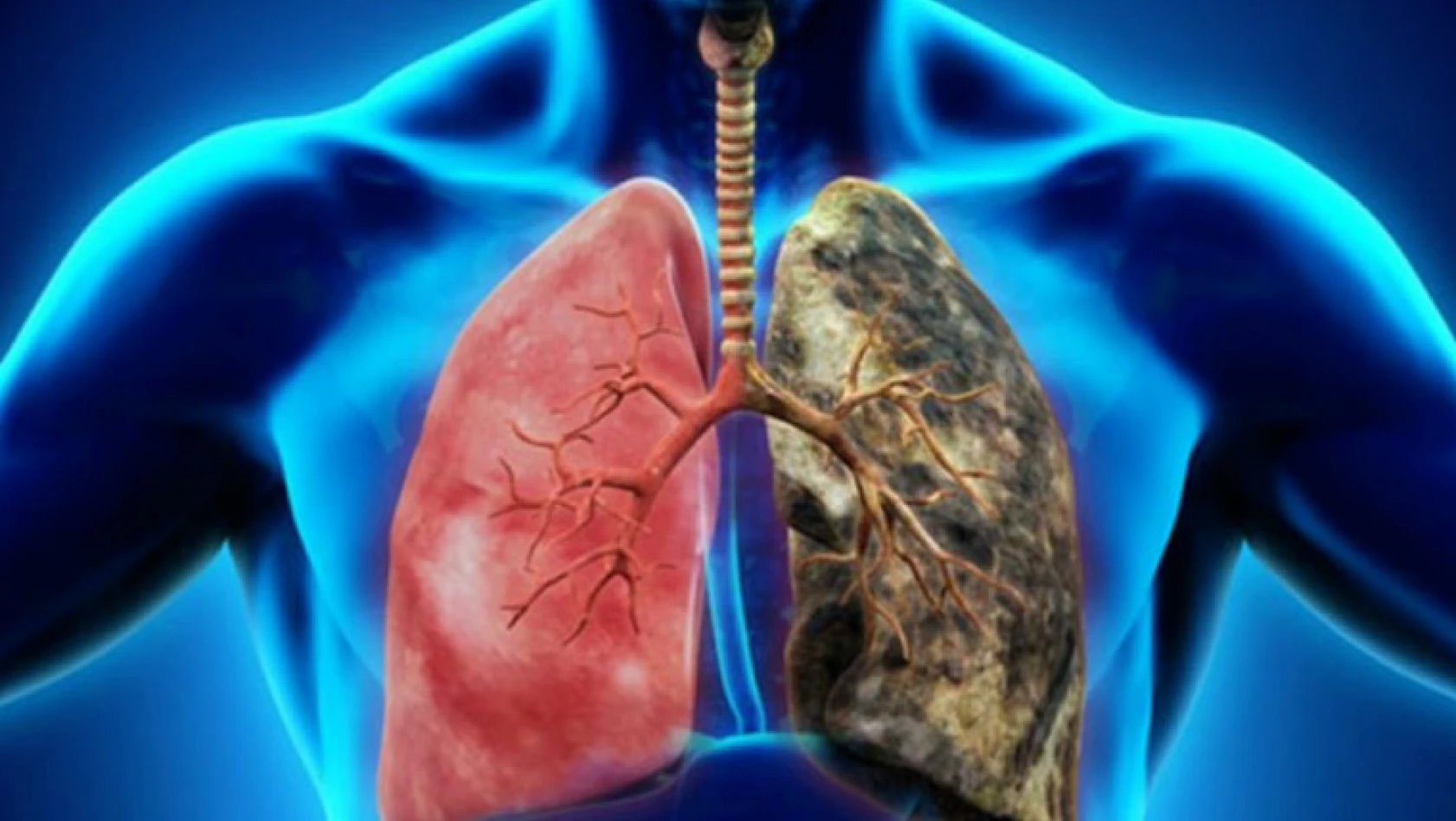 4 erkekten 1'i akciğer kanseri